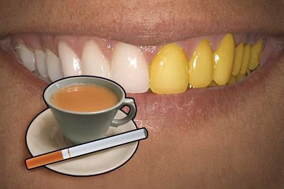 عوامل موثر در تغییر رنگ دندان‌ها