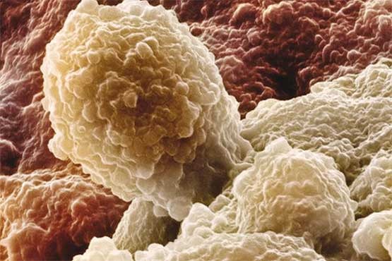 احتمال انتقال سرطان پروستات از طریق جنسی