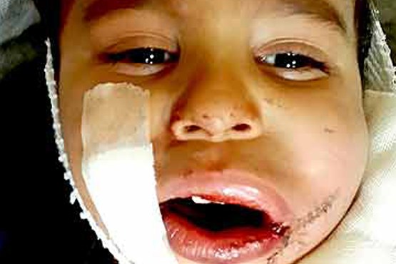 انفجار ترقه در دهان کودک 2 ساله انفجار ترقه در دهان کودک 2 ساله