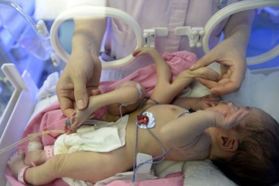 عمل جراحی روی نوزاد «8 دست ‌و پایی»