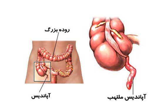 چرا آپاندیس پاره می‌شود