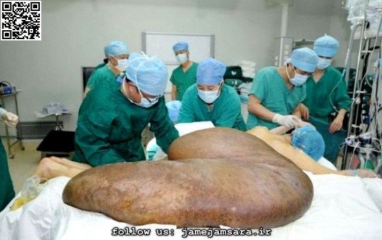 جراحی مردی با بزرگ‌ترین تومور در جهان |مجموعه عکس|