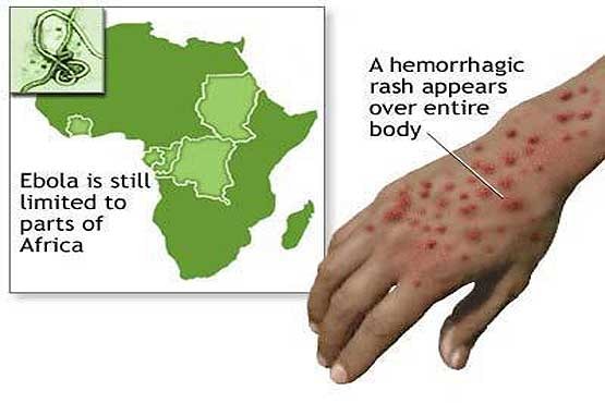 هشدار وزارت بهداشت به مسافران درباره بیماری ابولا