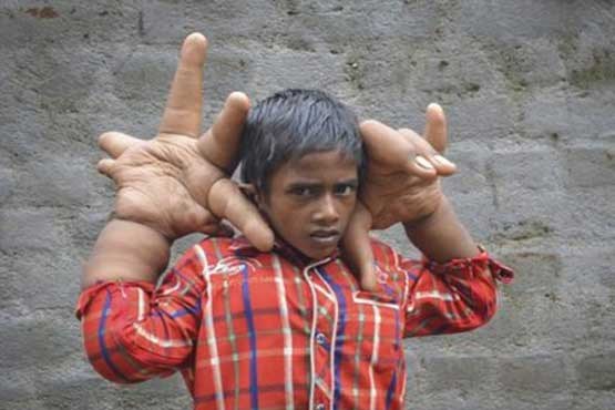 کودکی با دستهای عجیب
