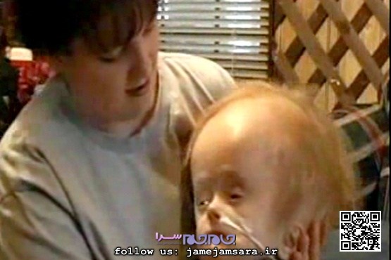 کودک بدون مغز در ۱۲ سالگی مُرد +عکس