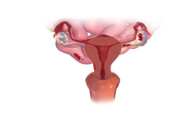 زنان مراقب باشند: اندومتریوز تخمدان‌ها را درگیر می‌کند