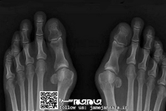 انحراف انگشت پا، عارضه‌ای شایع در زنان