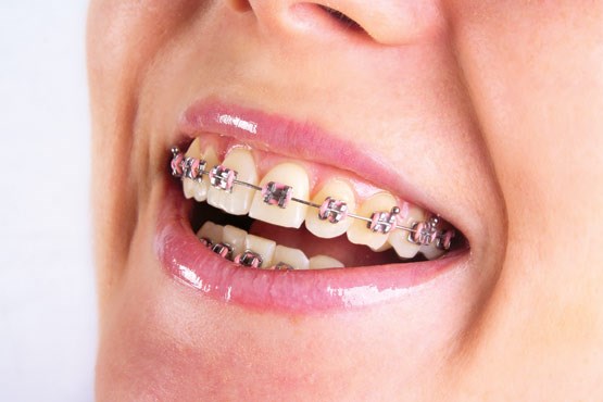 در طول ارتودنسی دندان ها چه خوراکی‌هایی نخوریم؟