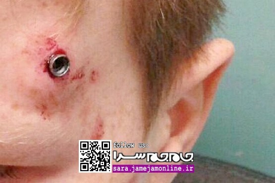 توقف ساچمه تفنگ بادی در سر کودک ۱۱ ساله [+عکس]
