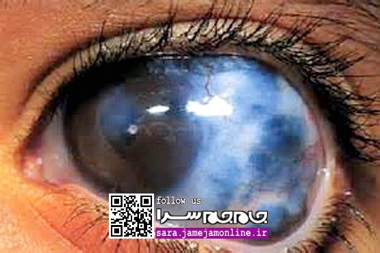 این بیماری خطرناک چشمی را بشناسید