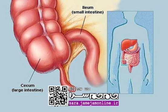 پاسخ یک متخصص به شایعه افزایش عمل آپاندیس بعد از گرانی ناشی از طرح تحول سلامت