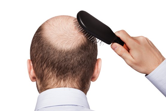 علت تضعیف ریشه موی سر