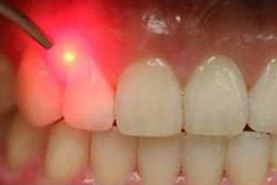 پوسیدگی دندان با روش جدید درمان شد