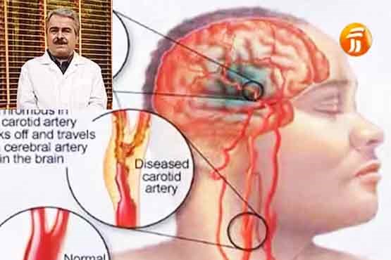 دکتر سلام / راهکارهای بهبود سکته مغزی چیست؟ +فیلم