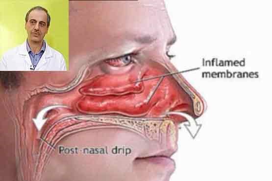 دکتر سلام / درمان  سینوزیت حاد چیست؟ +فیلم