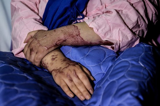 آمار بالای اسید سوزی در ایران