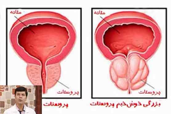 دکتر سلام / بزرگی خوش خیم پروستات چیست ؟ +فیلم