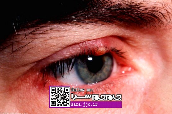 عفونت‌های چشمی: شالازیون و گل مژه