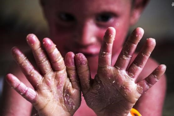 کودک 6 ساله با بیمار نادر پوستی به شبکه 2 می‌آید