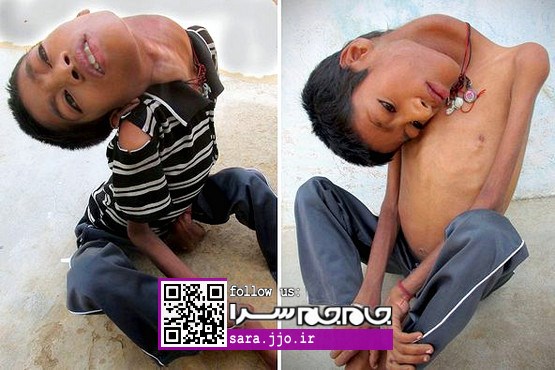 بیماری عجیب: پسری نوجوان با افتادگی ۱۸۰ درجه‌ای گردن! [عکس]