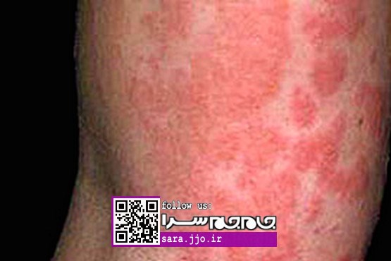 تشخیص خطرناکترین بیماری‌ها را از روی پوست