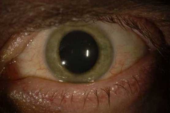 ابولا رنگ چشم را تغییر می‌دهد! + عکس