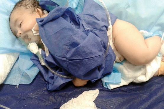 توضیح بیمارستان کیش درباره مرگ مشکوک نوزاد دو ماهه