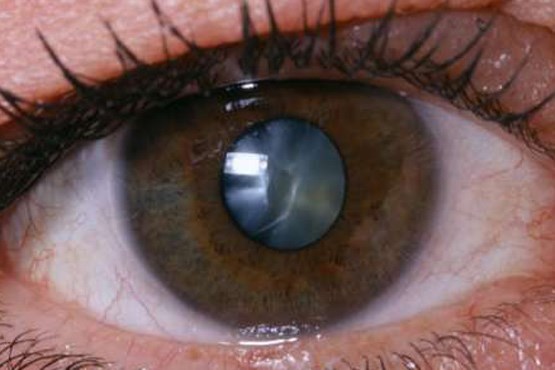 آب مروارید با قطره چشمی درمان شد