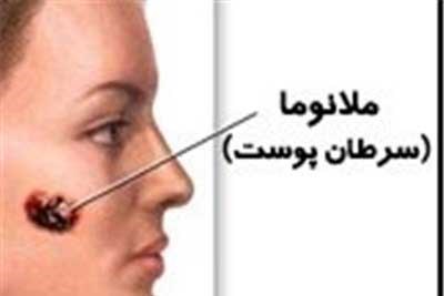 «پماد ضدآفتاب» ساده ترین راه جلوگیری از سرطان بدخیم پوست