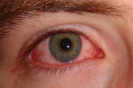 چگونگی پیشگیری از قرمزی چشم هنگام شنا کردن