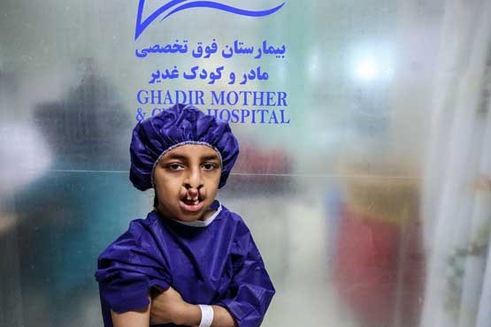 درمان انیسه بیمار شکاف کام در شیراز + عکس