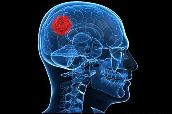 عوامل بروز تومور مغزی و علائم آن