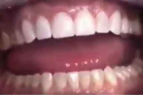 ۵ تا ۶ میلیون ایرانی اصلا دندان ندارند