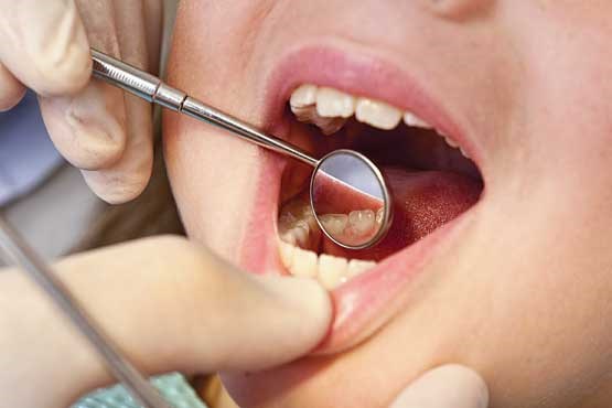 تولید ماده شیشه‌ای برای پُرکردن دندان