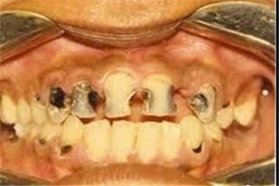 پنج توصیه مهم درباره پوسیدگی ‌دندانها + موثرترین روش پیشگیری