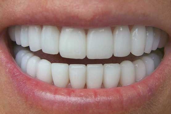با این روش درمانی به دندان های خود زیبایی ببخشید