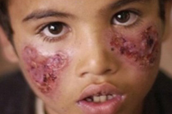 اجساد رها شده سوری ها  عامل ایجاد حشرات گوشتخوار