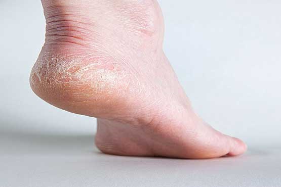 آیا درد کمر و زانو به کف پا ربط دارد؟