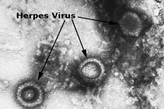 عامل اصلی انتقال ویروس درمان ناپذیر تبخال تناسلی را جدی بگیرید!