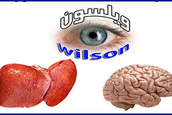 «ویلسون» یا رسوب مس در مغز و کبد
