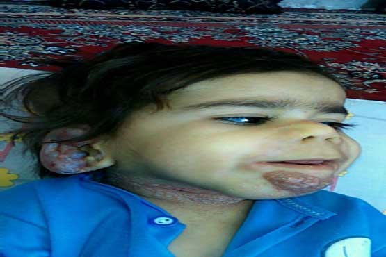 کودک 3 ساله ، تنها بیمار فاربر در ایران  + عکس