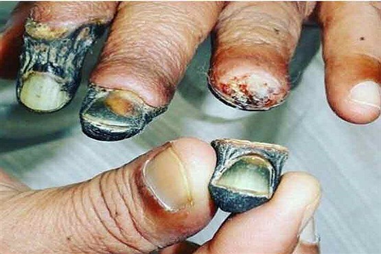 تصویری هولناک از کنده شدن انگشتان دست بر اثر قانقاریا