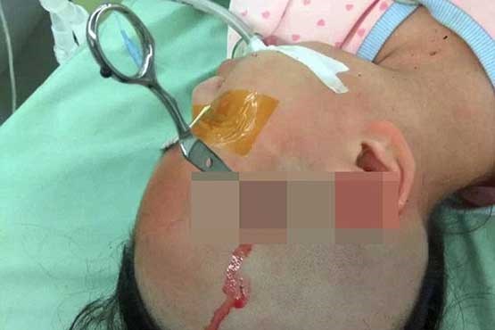 پدر بی‌رحم قیچی را در سر دخترش فرو کرد +عکس