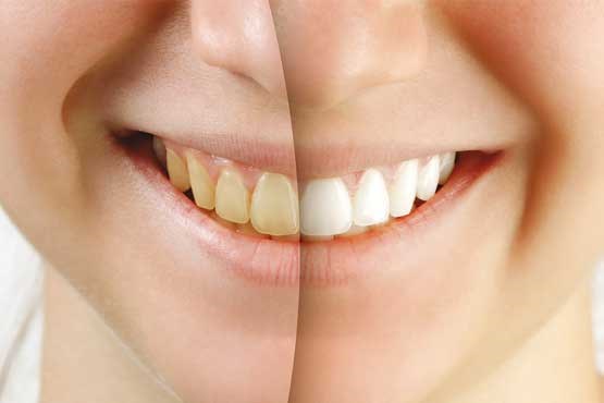 آیا سفید کردن دندان‌ها روش قابل اعتمادی است؟