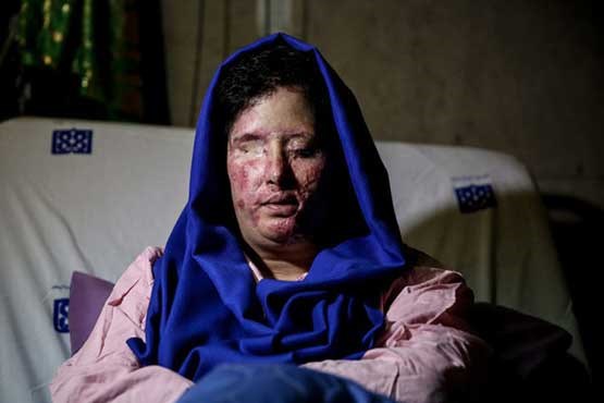 روایت قربانی اسیدپاشی اصفهان از رنج‌هایش