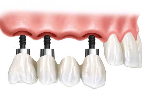 آنچه از جایگزینی دندان باید بدانیم