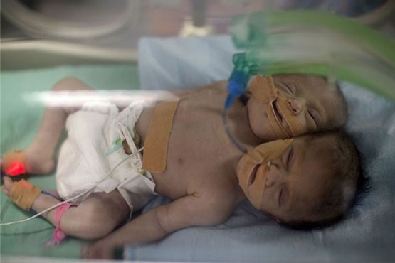 تولد نوزاد دو سر در غزه +عکس