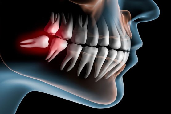 کیست‌هایی که در ناحیه دندان عقل رشد می‌کنند