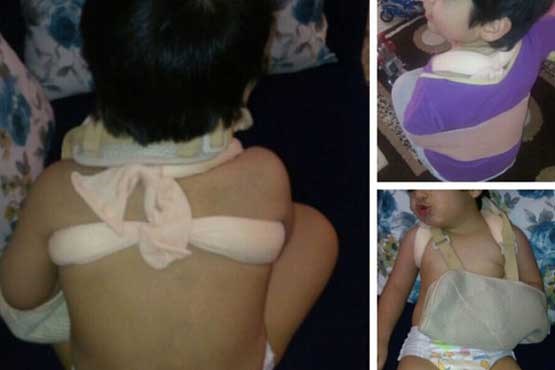 شکستن استخوان پسر 3 ساله در مهدکودک +عکس