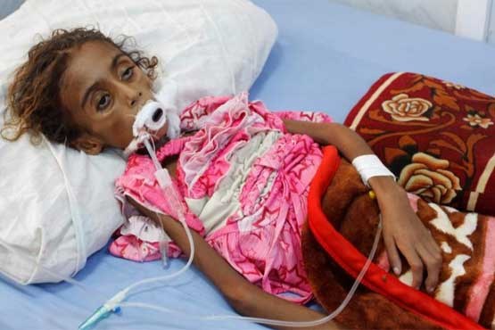 تصاویر تلخ از مرگ دختر ۷ ساله یمنی بر اثر سوءتغذیه